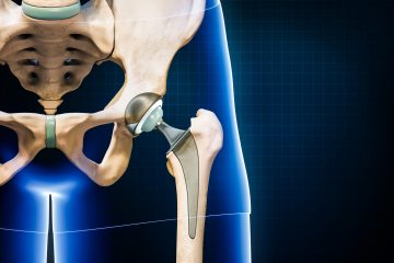 Hip prosthesis or implant isolated on blue background with copy space. Hip joint or femoral head replacement 3D rendering illustration. Medicine, medical and healthcare, surgery, science concepts.